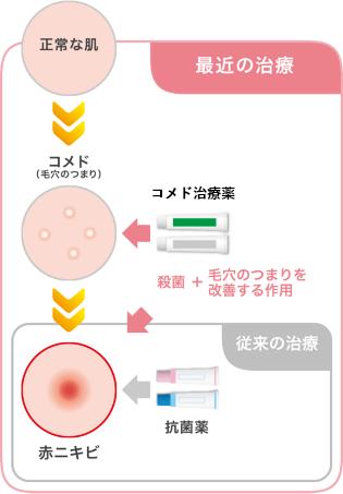 コメド 治し 方