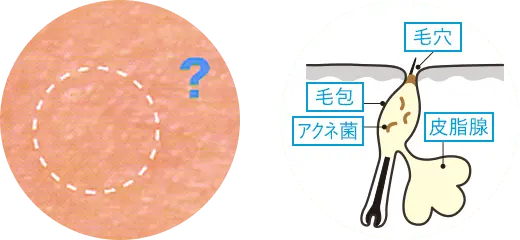 マイクロコメド(微小面ぽう)の画像と毛穴の断面図