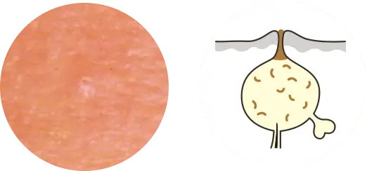 白ニキビの画像と毛穴の断面図