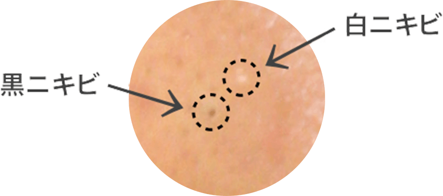 治し 白 方 ニキビ