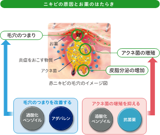 ニキビの原因とお薬のはたらき
