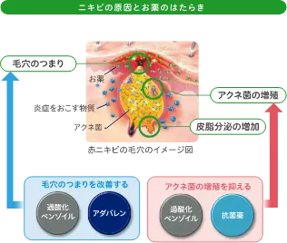 ニキビの原因とお薬のはたらき