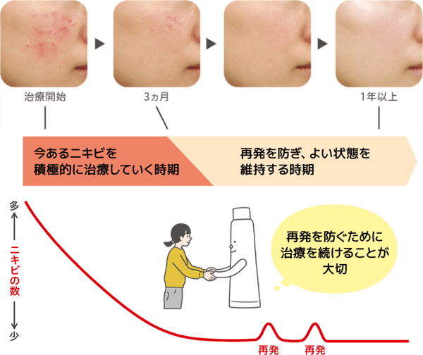 ニキビの治り方
