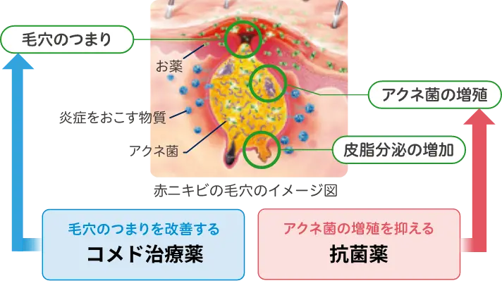 ニキビの原因とゼビアックスのはたらき