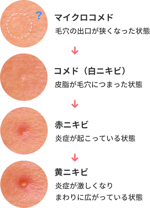 皮膚科で治療できるニキビの種類