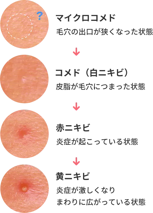 皮膚科で治療できるニキビの種類