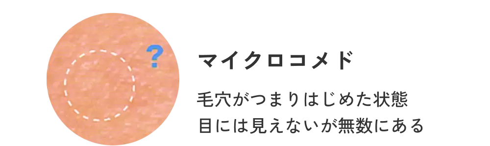 マイクロコメド 毛穴がつまりはじめた状態。目には見えないが無数にある。