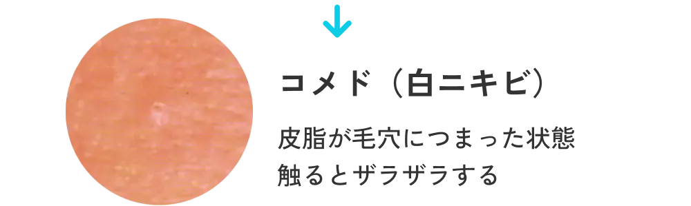 コメド（白ニキビ） 皮脂が毛穴につまった状態。触るとザラザラする。
