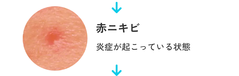 赤ニキビ 炎症が起こっている状態