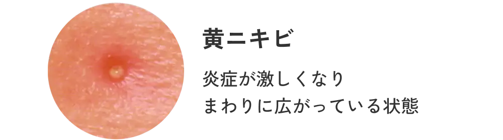 黄ニキビ 炎症が激しくなりまわりに広がっている状態