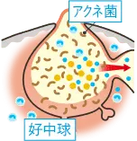 黄ニキビの毛穴の断面図