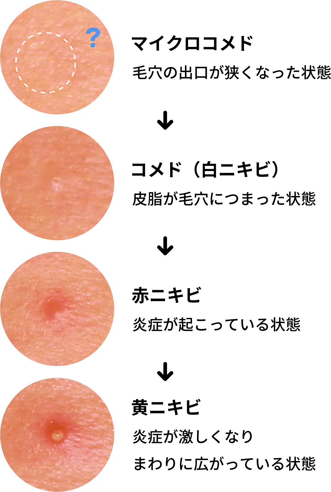 皮膚科で治療できるニキビの種類