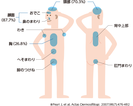 症状が出やすい部位（割合）