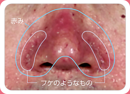 顔の脂漏性皮膚炎 重症度