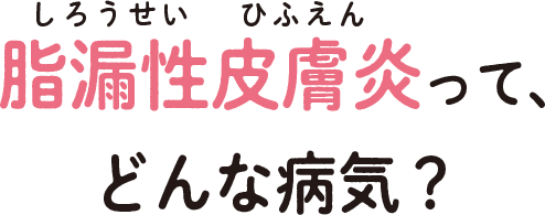 脂漏性皮膚炎ってどんな病気？