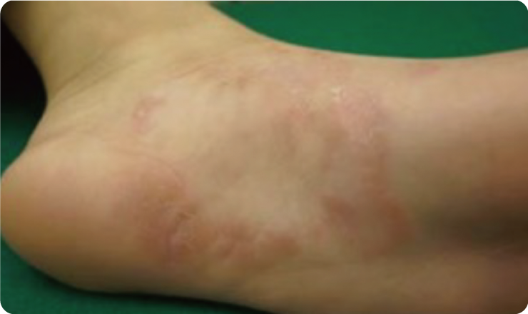 足の尋常性乾癬の様子