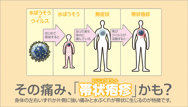 その痛み、「帯状疱疹」かも？