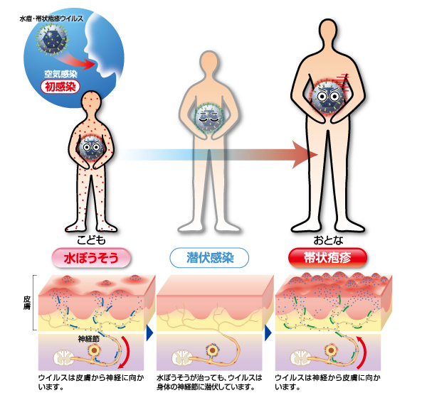 水ぼうそうと帯状疱疹の関係