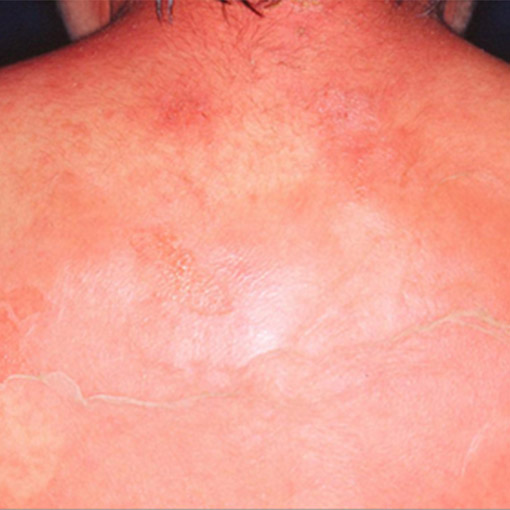 ブドウ球菌性熱傷様皮膚症候群（SSSS）