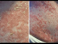 写真：Journal of the American Academy of Dermatology 提供<br />無断複写・転載禁止