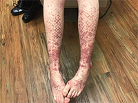 写真：Journal of the American Academy of Dermatology 提供<br />無断複写・転載禁止