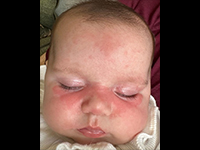 写真：Journal of the American Academy of Dermatology 提供<br />無断複写・転載禁止