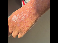 Margaret Webb, MD, FAAD. 提供 無断複写・転載禁止