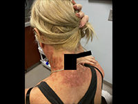 写真：Journal of the American Academy of Dermatology 提供<br />無断複写・転載禁止