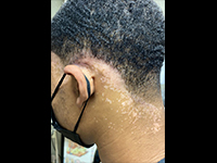 写真：Journal of the American Academy of Dermatology 提供<br />無断複写・転載禁止