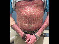 写真：Journal of the American Academy of Dermatology 提供<br />無断複写・転載禁止