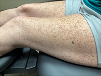 写真：Journal of the American Academy of Dermatology 提供<br />無断複写・転載禁止