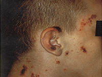 Nejm Knowledge Dermado デルマド マルホ株式会社 皮膚科学領域での卓越した貢献を