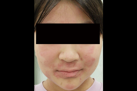 第11回：小児アトピー性皮膚炎の新常識：移行期医療と皮膚科心身医学的アプローチ