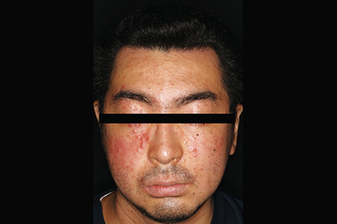 第12回：単純ヘルペスの新常識：抗体検査と抗原検査