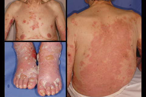 第16回：水疱性類天疱瘡の新常識：薬剤が発症誘因となりうる