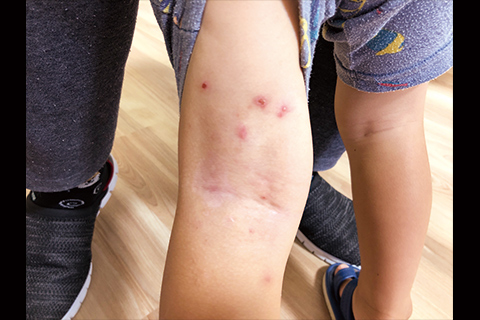 第17回：伝染性膿痂疹（とびひ）の新常識：病変範囲に応じた治療選択
