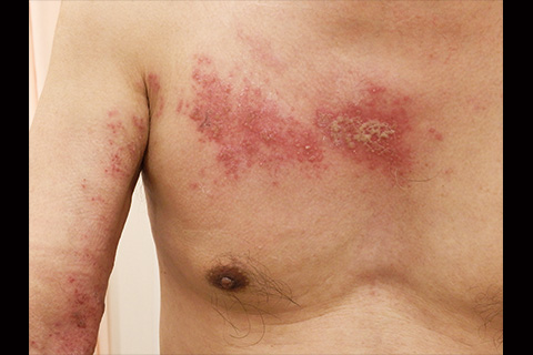 第18回：帯状疱疹の新常識：薬剤投与量の調節