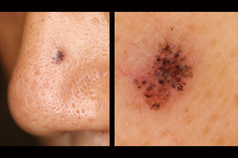 第19回：皮膚癌の新常識：他疾患との鑑別