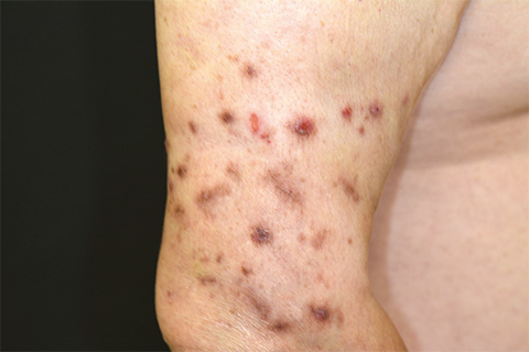 第20回：結節性痒疹の新常識：末梢神経障害の合併は稀ではない