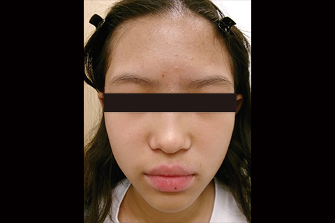 第24回：尋常性ざ瘡の新常識：面皰期の治療におけるショートコンタクトセラピー薬剤の使いどころ