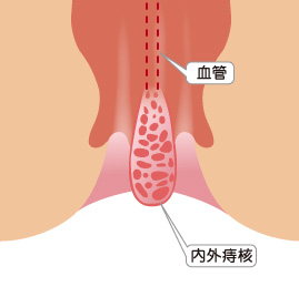 (1) 結紮切除術