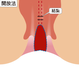 (1) 結紮切除術