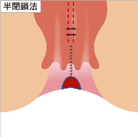 (1) 結紮切除術