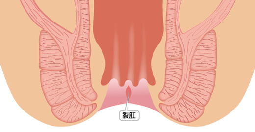 急性裂肛
