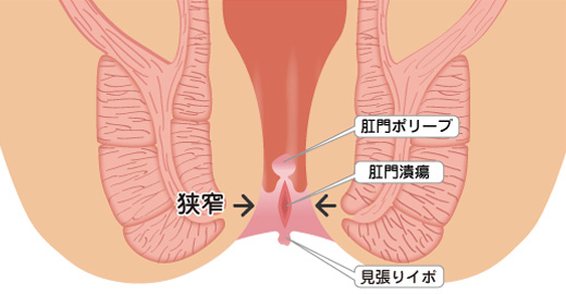 慢性裂肛