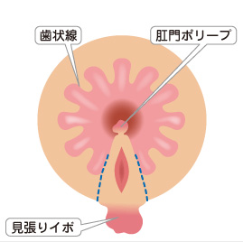 裂肛切開術