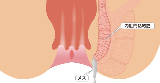 側方皮下内肛門括約筋切開術（LSIS）