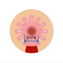 皮膚便移動術（SSG）