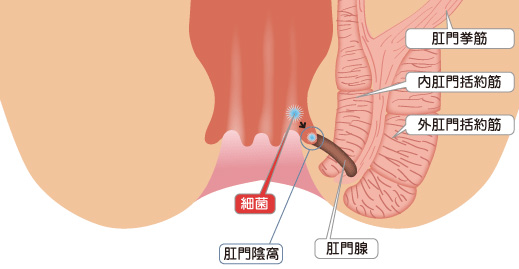 痔瘻
