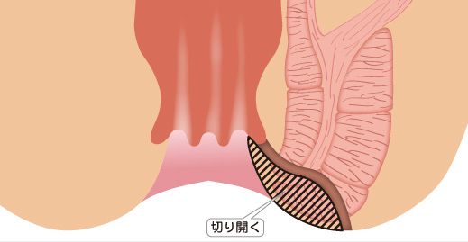 切開開放術（lay open法）